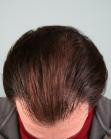 Before Hair Transplant&nbsp;Front